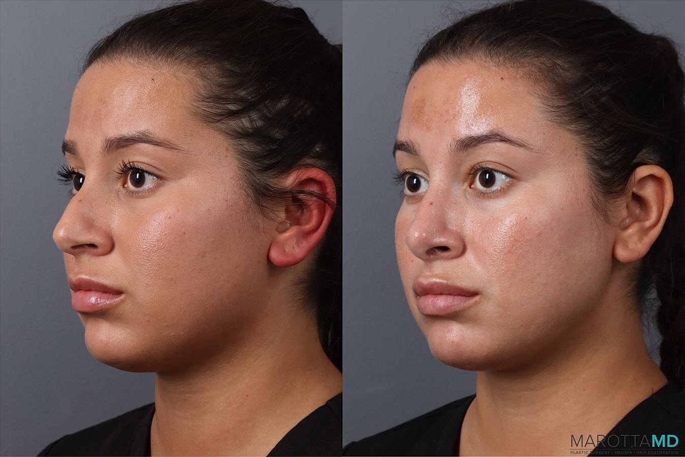 Nose Surgery Before & After