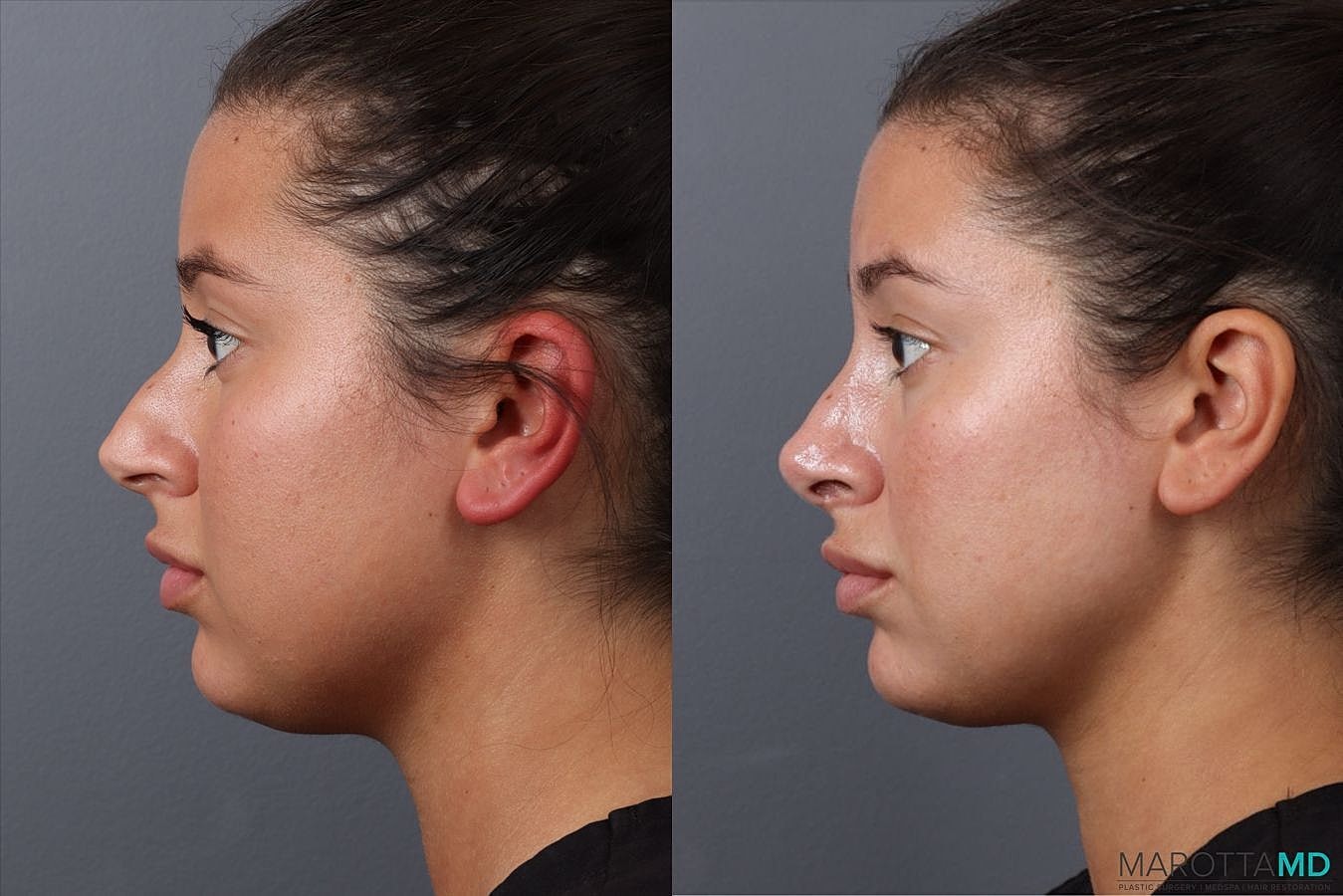 Nose Surgery Before & After