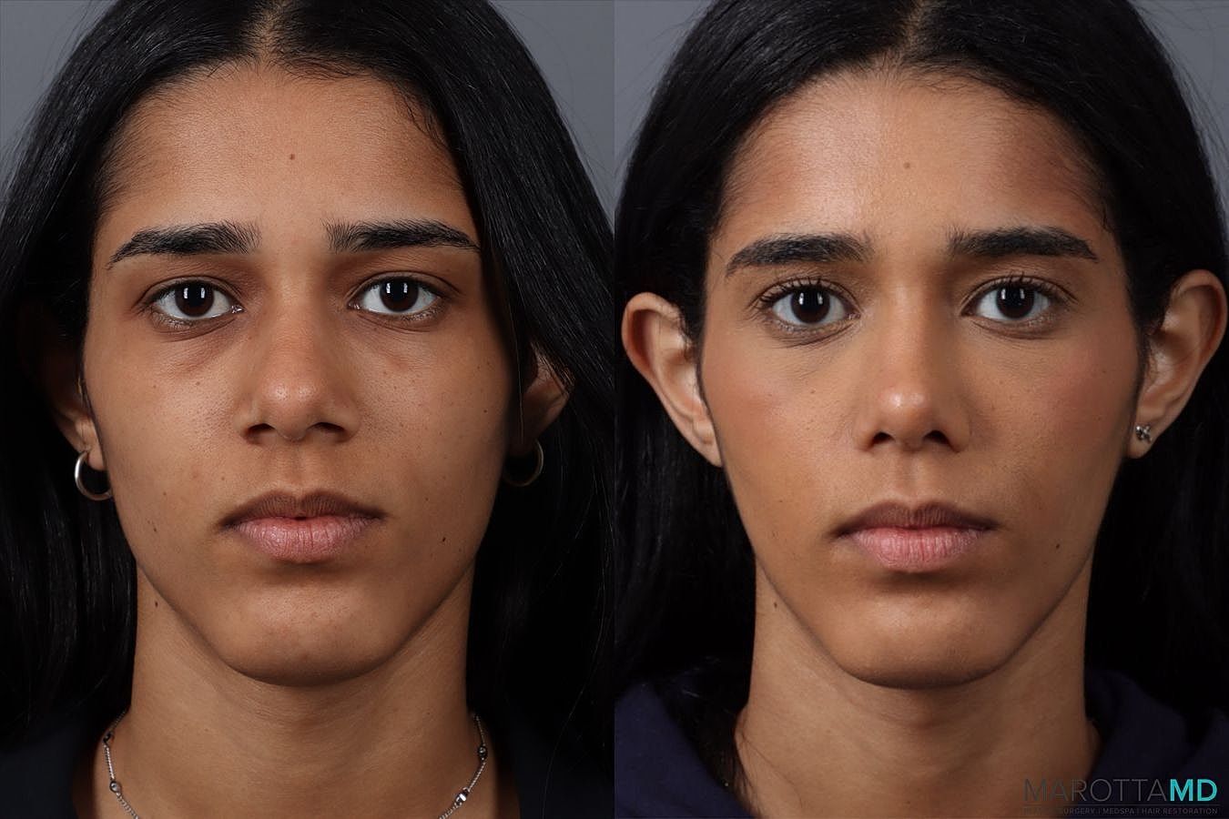 Nose Surgery Before & After