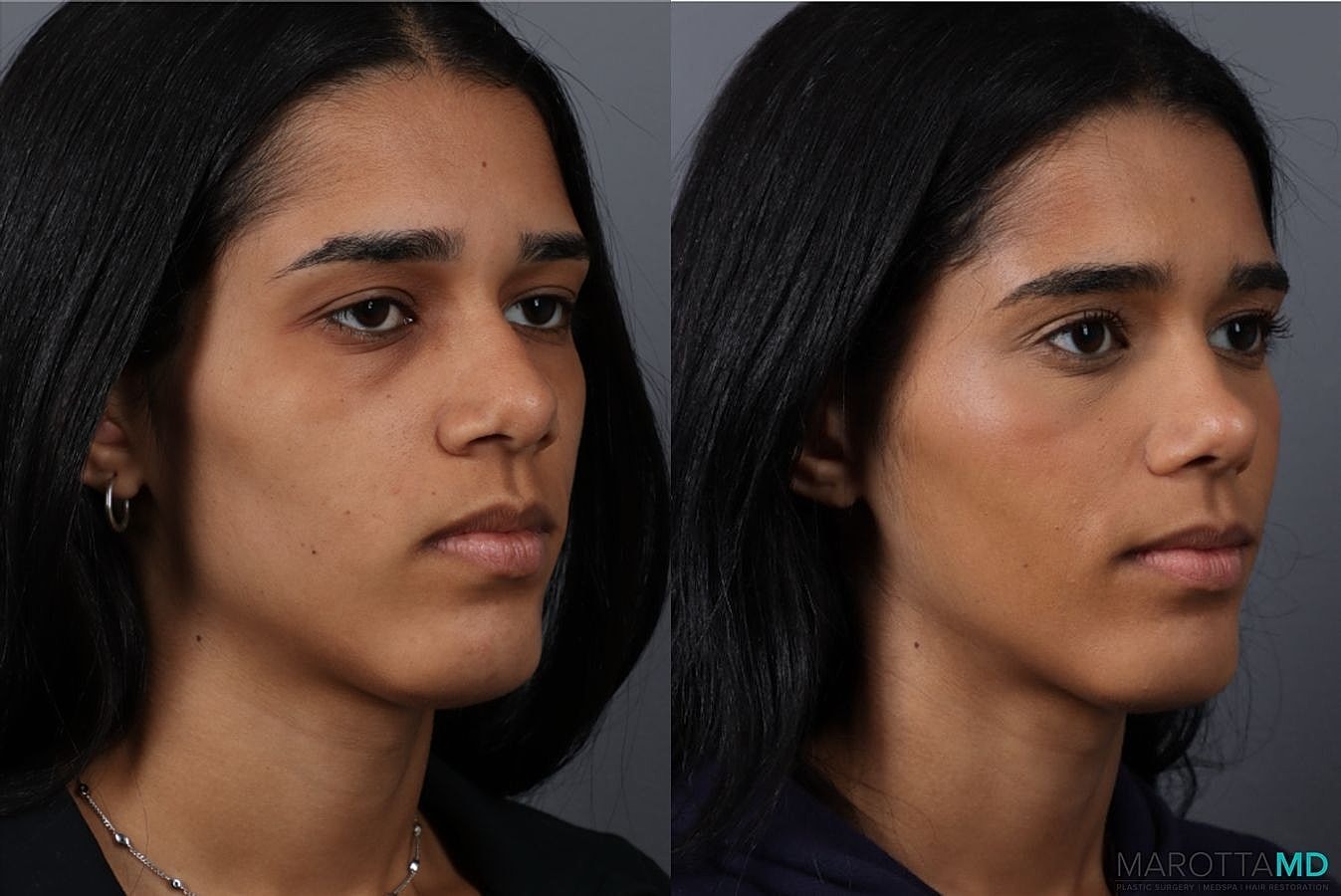 Nose Surgery Before & After
