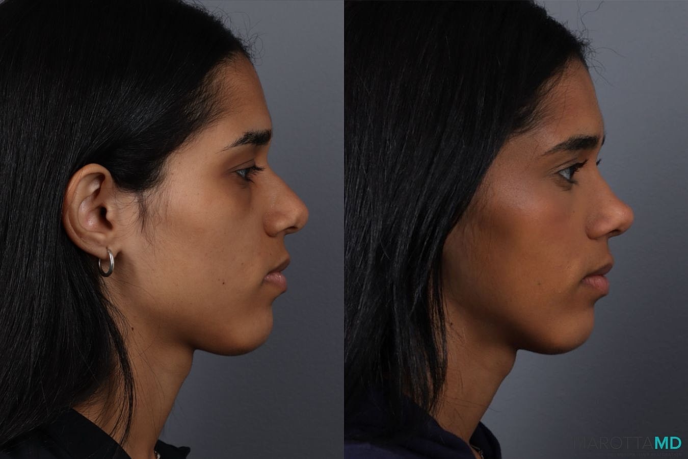 Nose Surgery Before & After