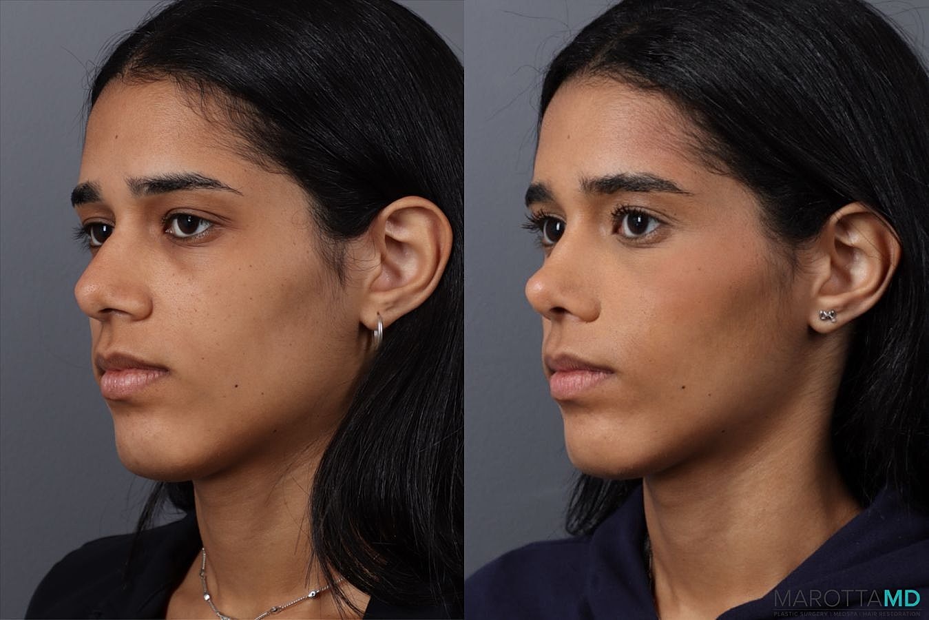 Nose Surgery Before & After