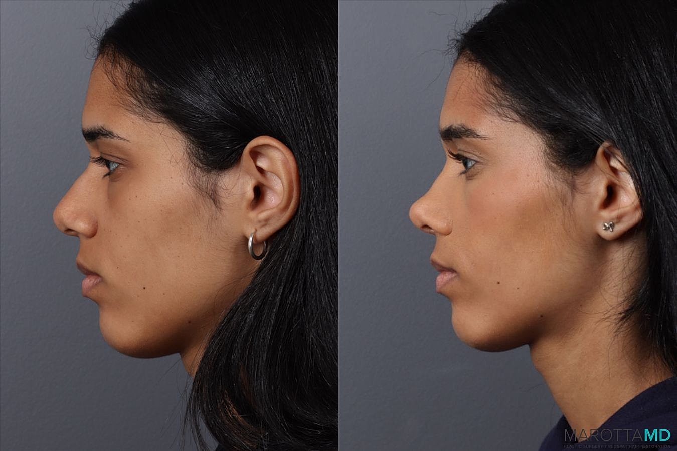 Nose Surgery Before & After