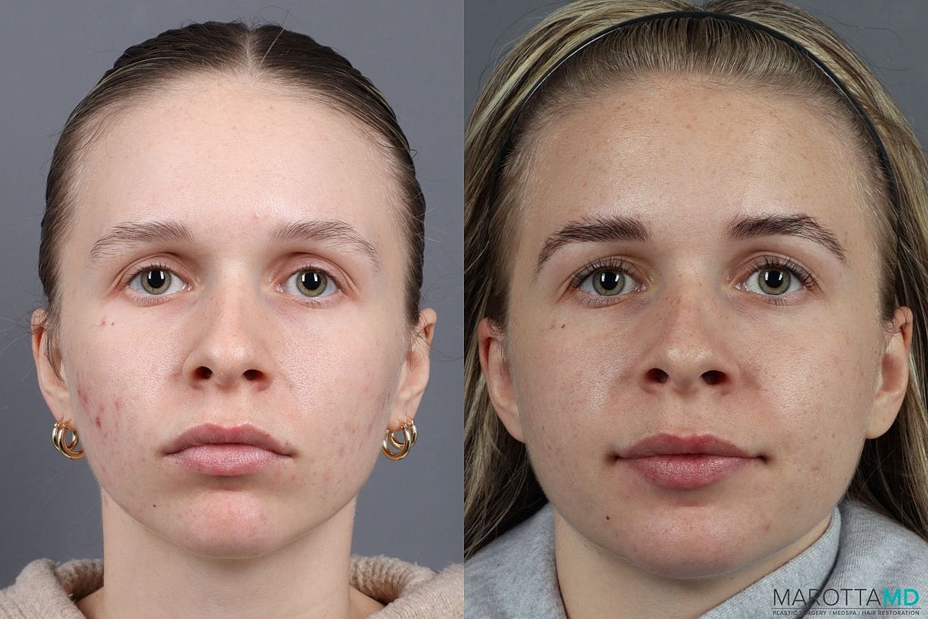 Dermalinfusion Before & After
