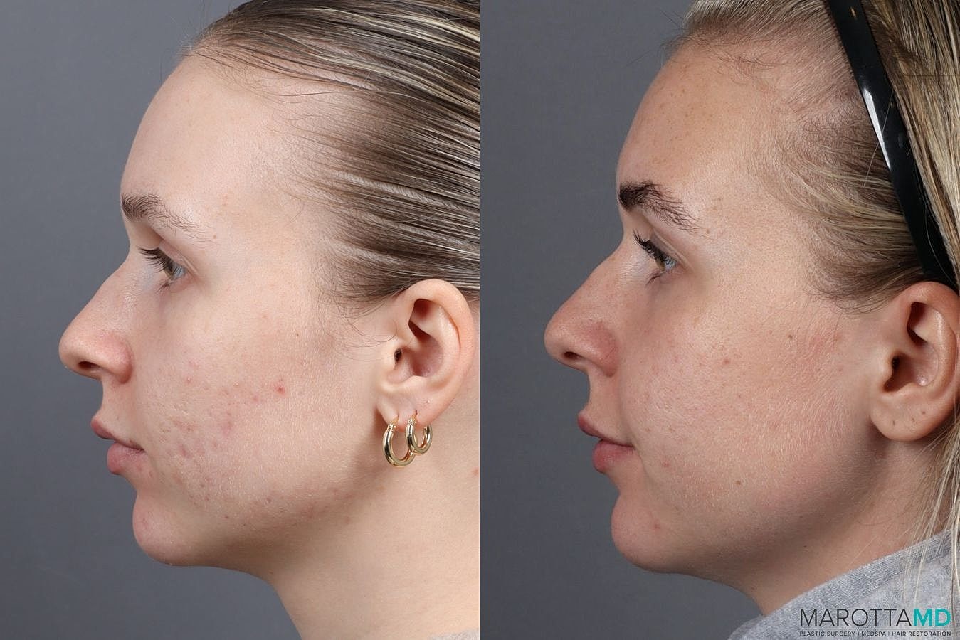 Dermalinfusion Before & After