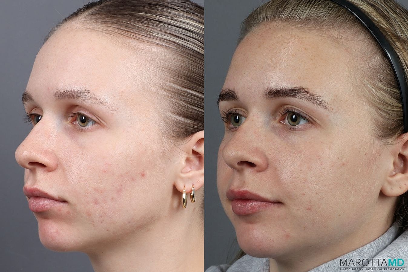 Dermalinfusion Before & After