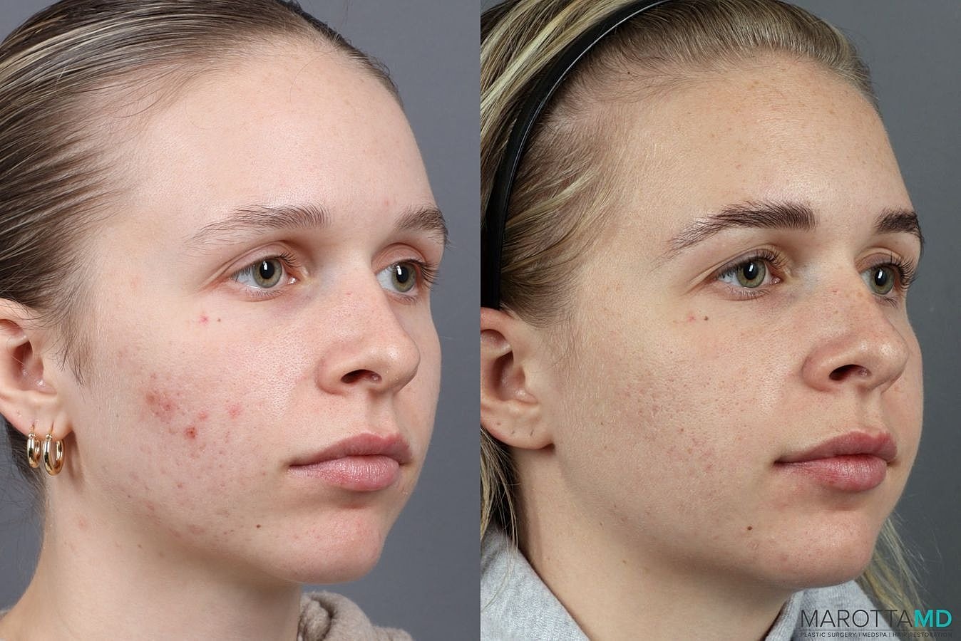 Dermalinfusion Before & After