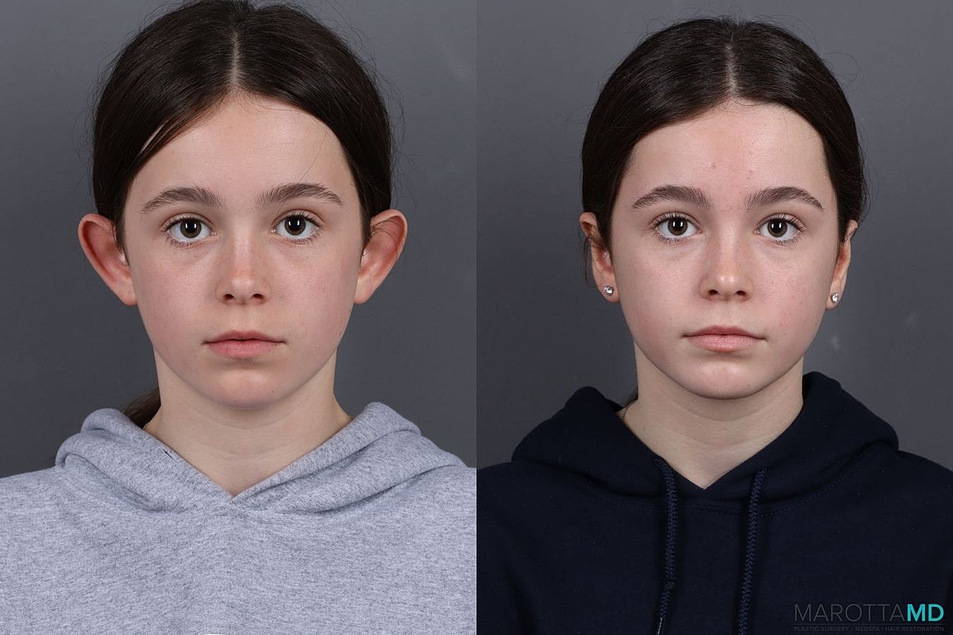 Ear Surgery Before & After
