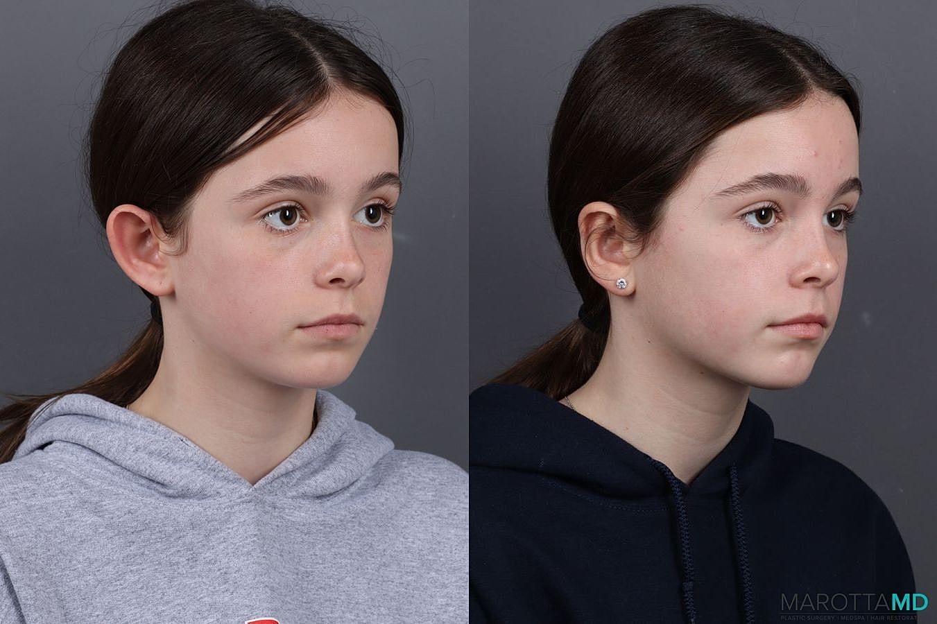 Ear Surgery Before & After