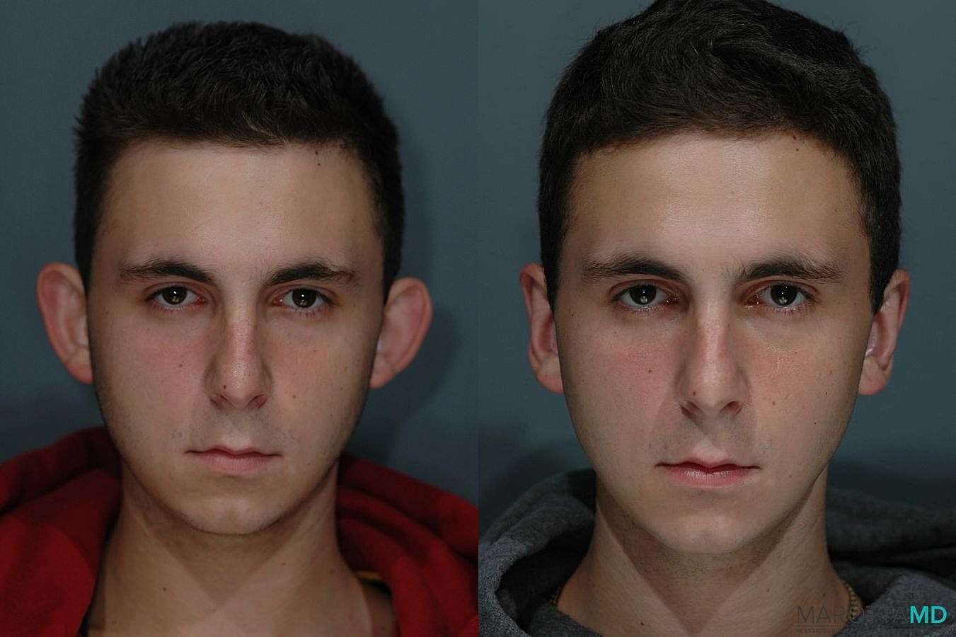 Ear Surgery Before & After