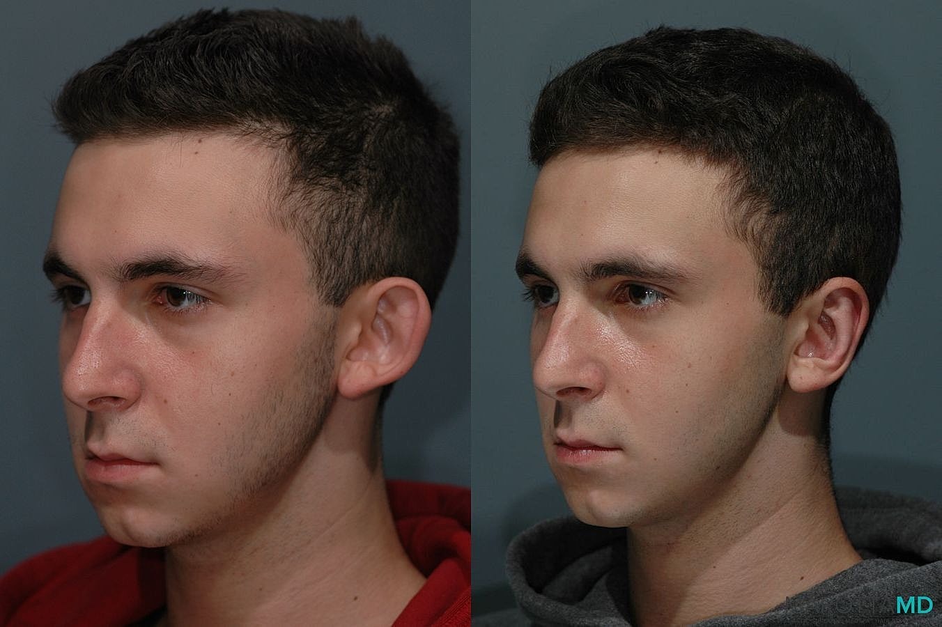 Ear Surgery Before & After