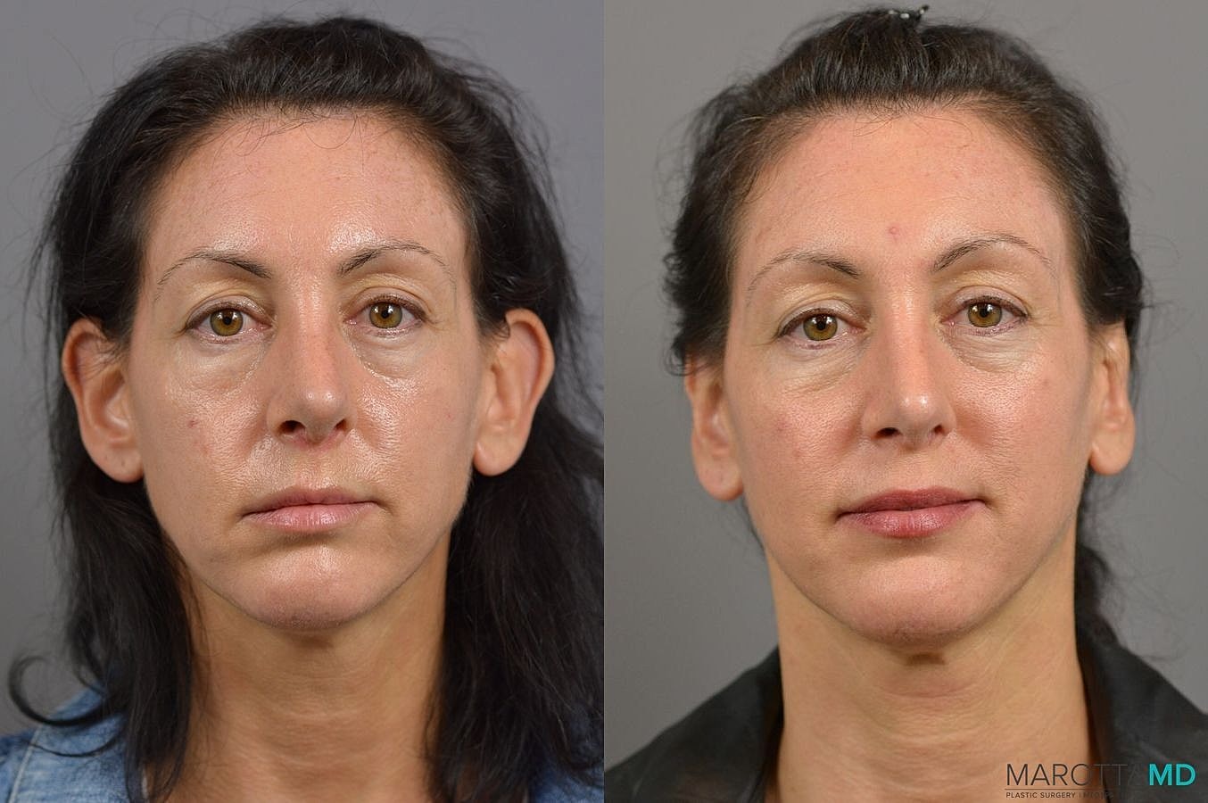Ear Surgery Before & After