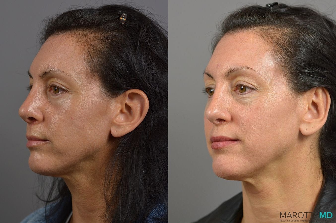 Ear Surgery Before & After