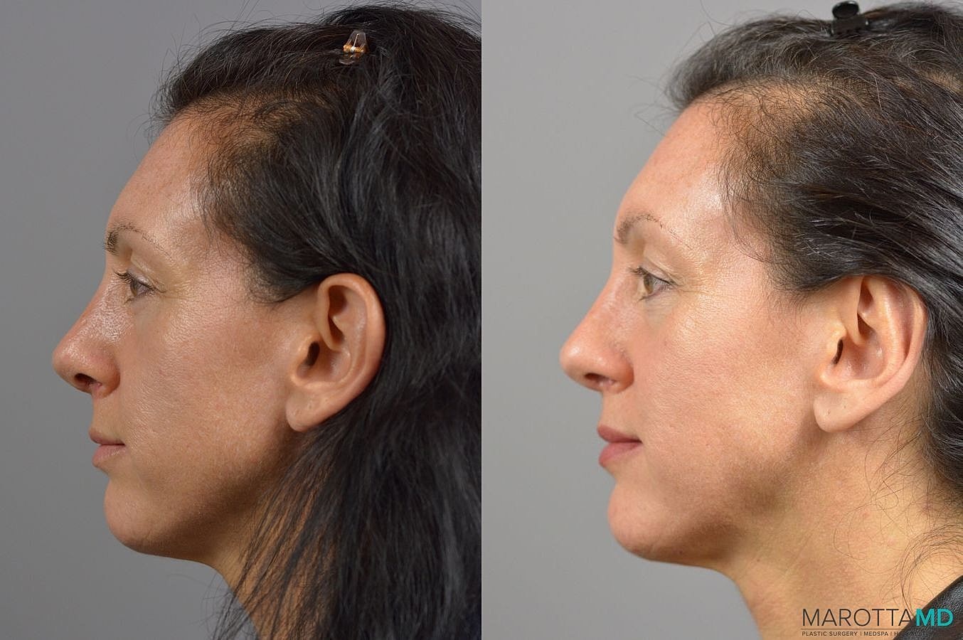 Ear Surgery Before & After