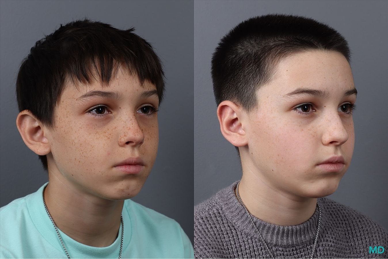 Ear Surgery Before & After