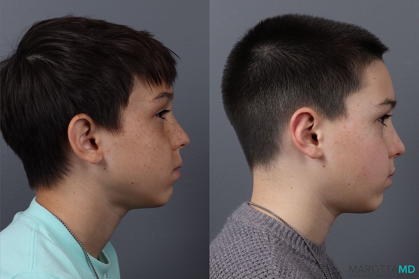 Ear Surgery Before & After