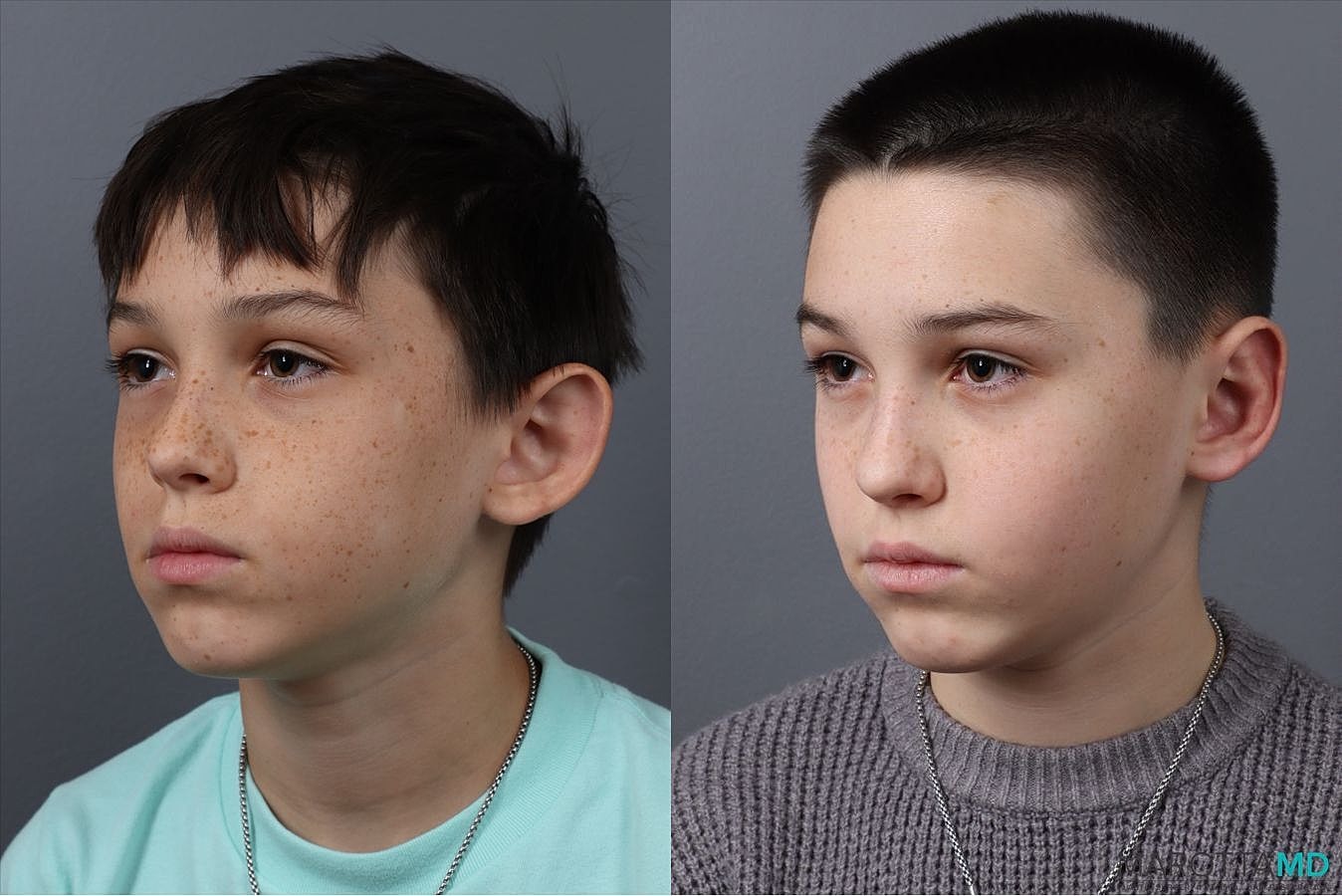 Ear Surgery Before & After