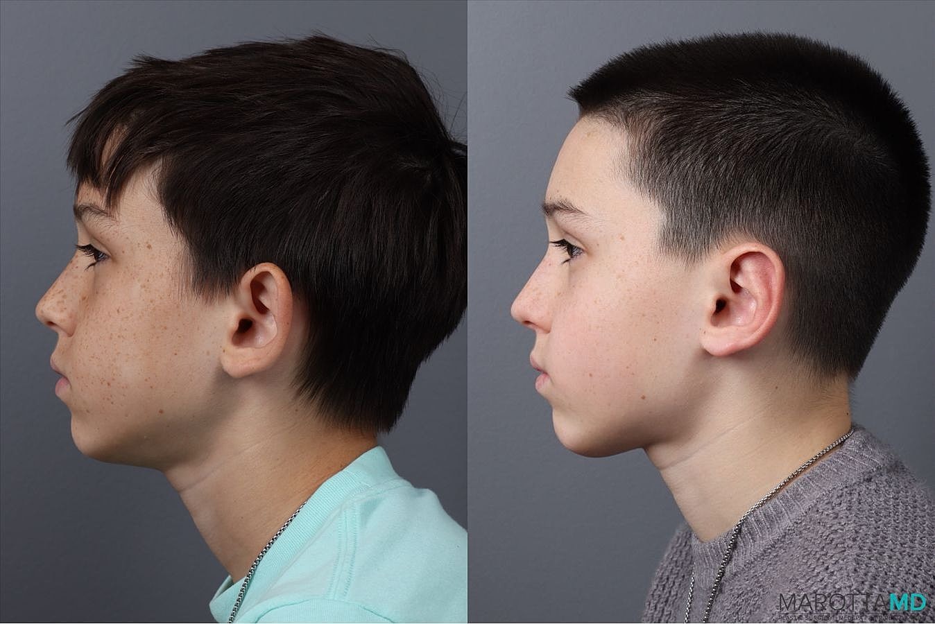 Ear Surgery Before & After