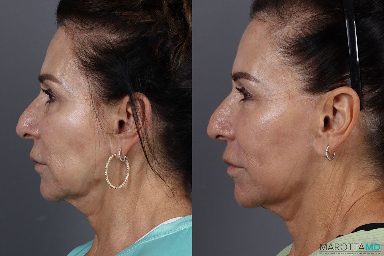 Threeforme Before & After