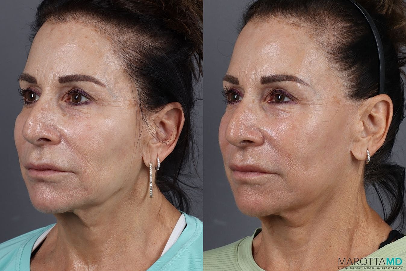 Threeforme Before & After