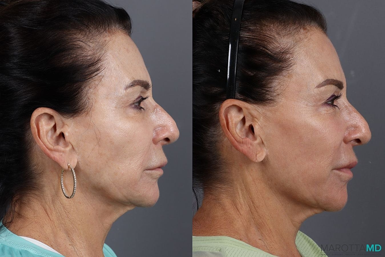 Threeforme Before & After