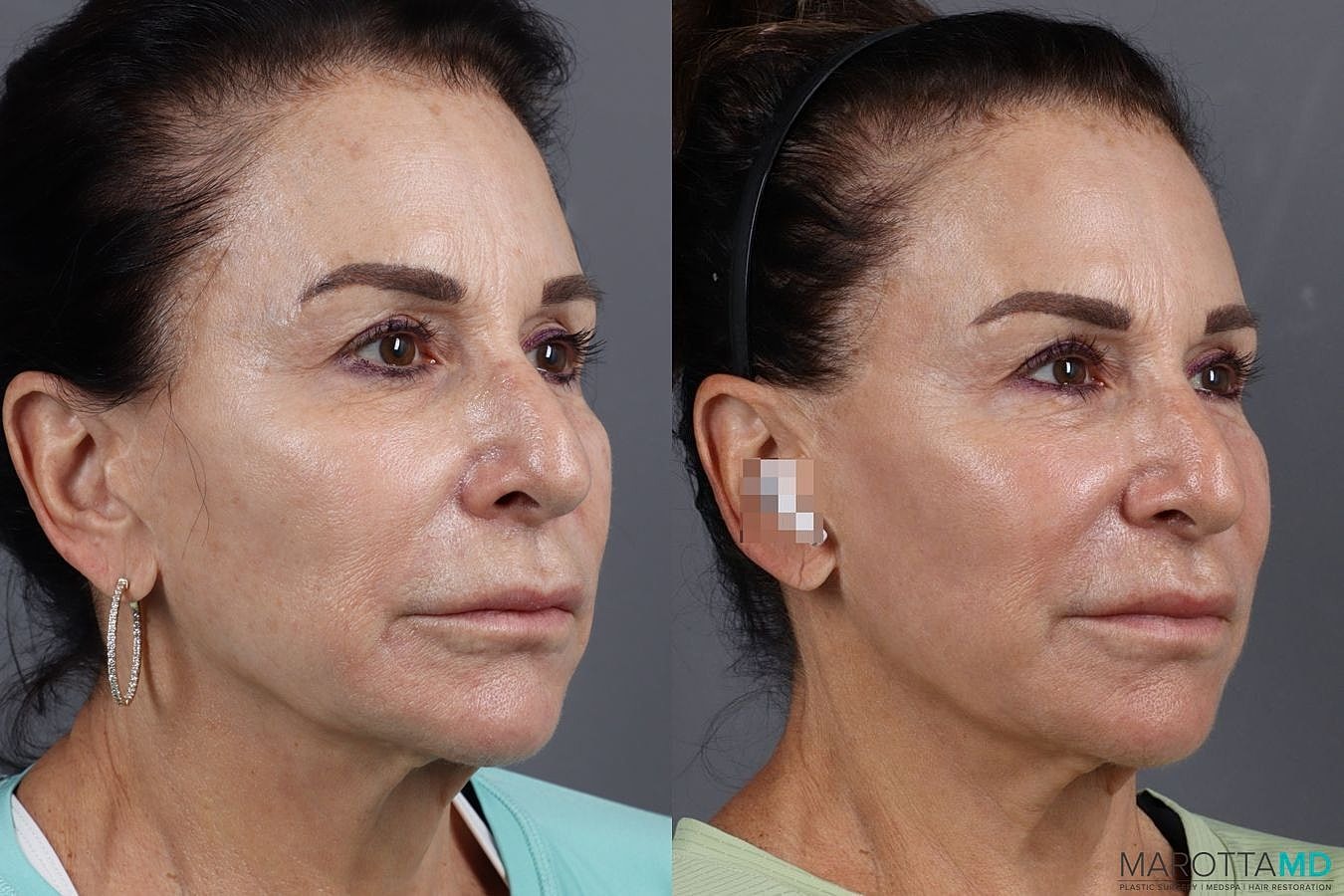 Threeforme Before & After
