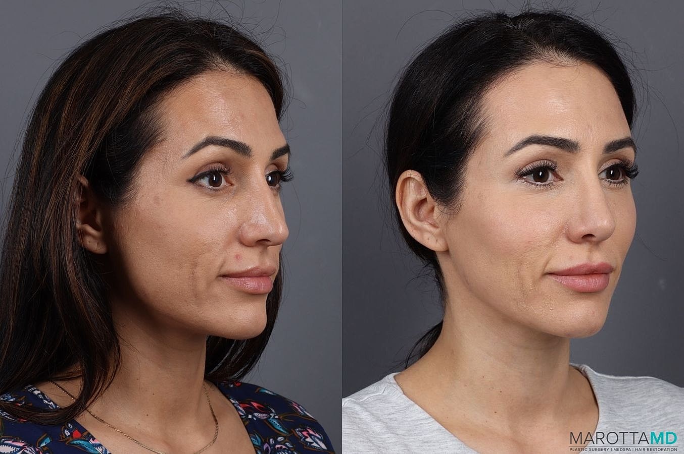 Skinvive Before & After