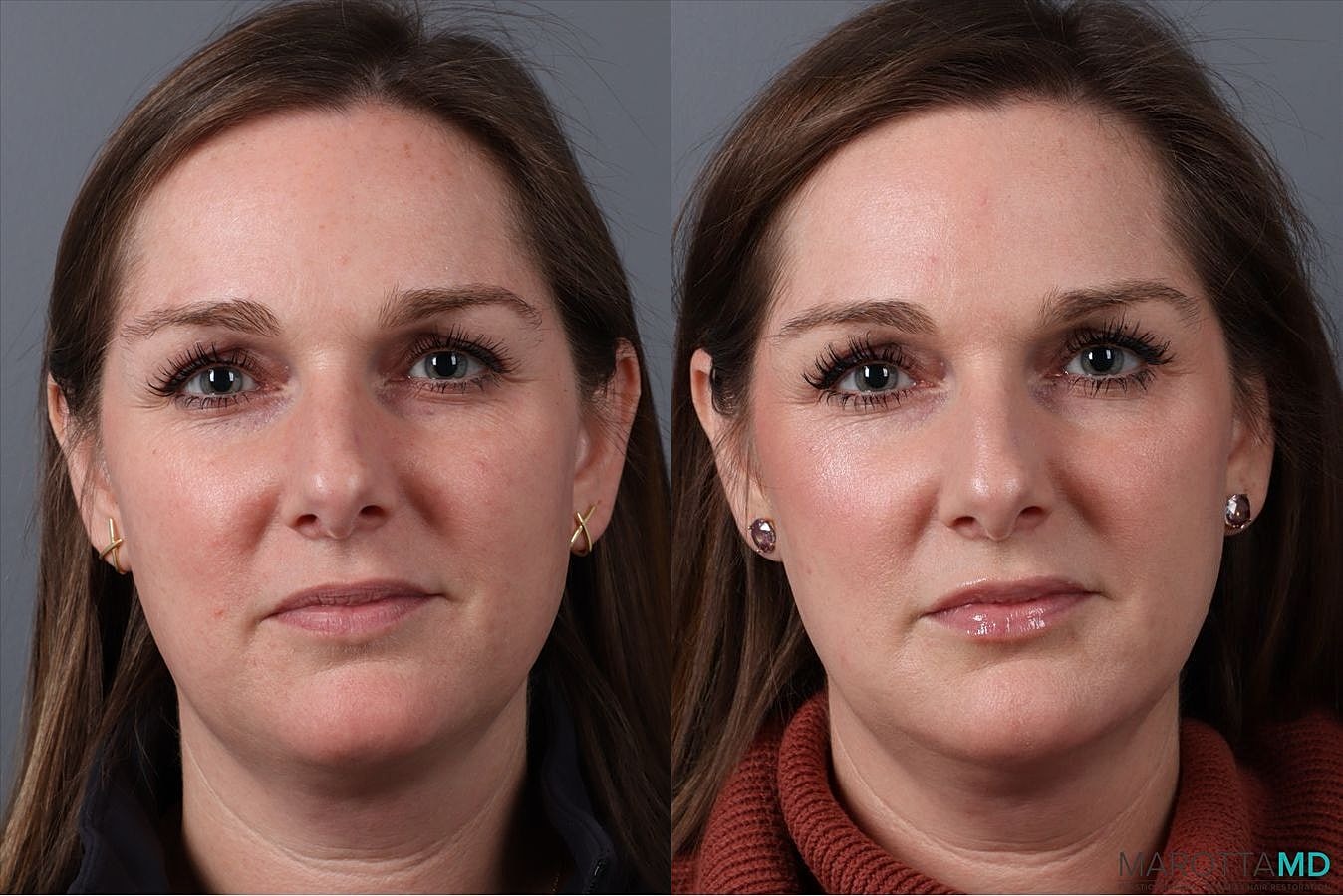 Skinvive Before & After