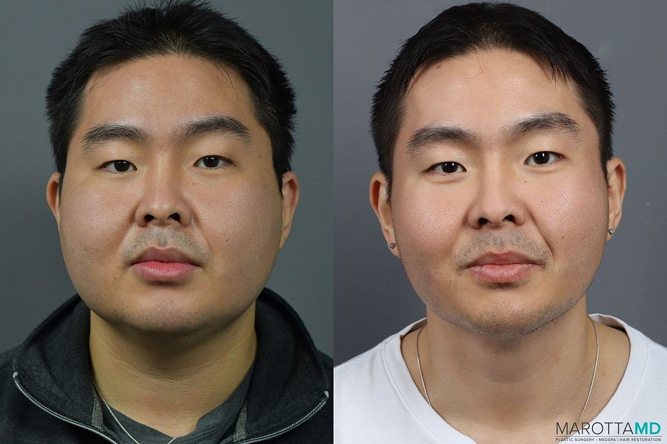 Buccal Fat Removal Before & After