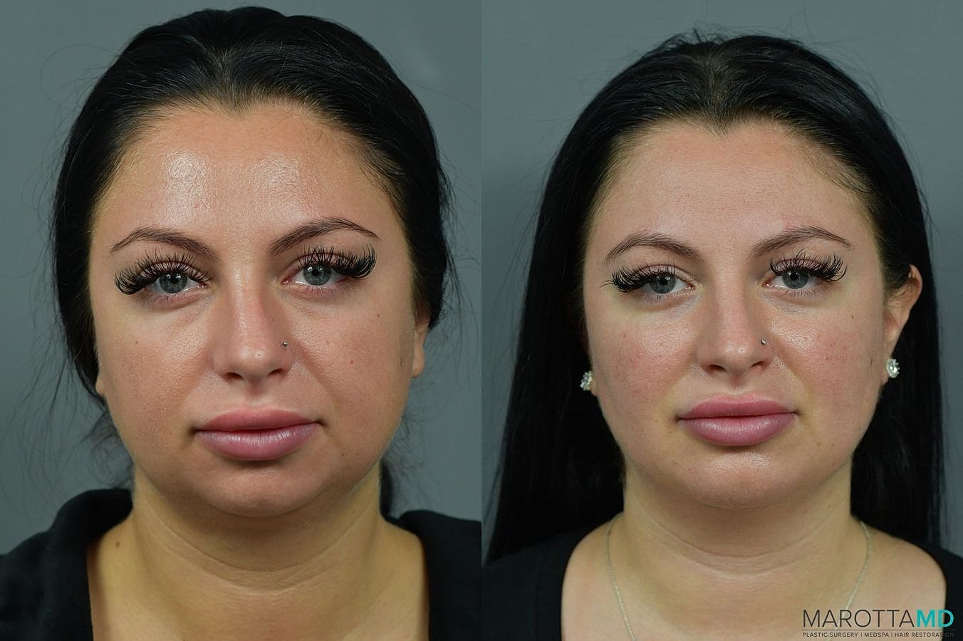 Buccal Fat Removal Before & After