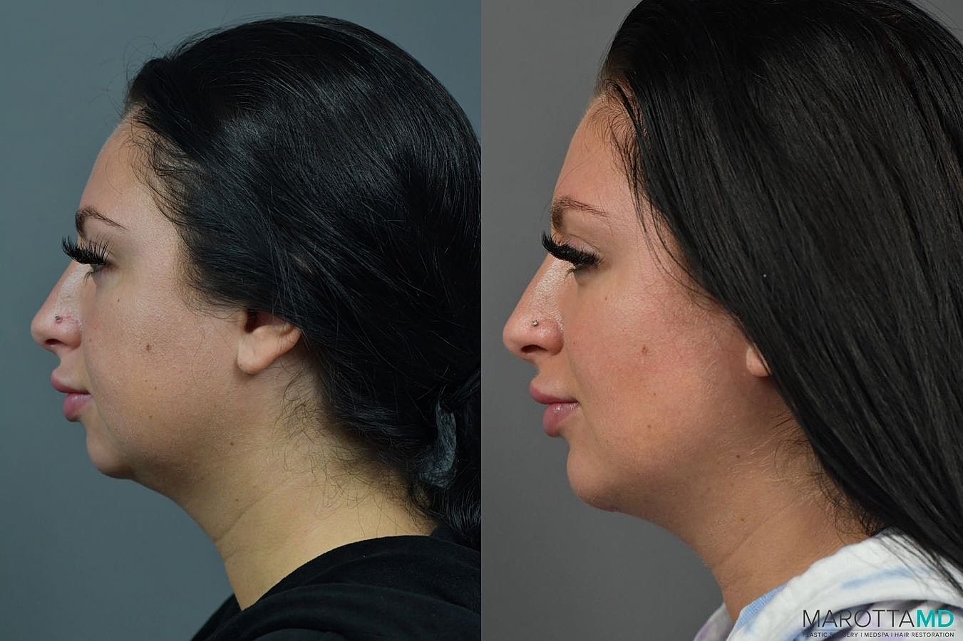 Buccal Fat Removal Before & After