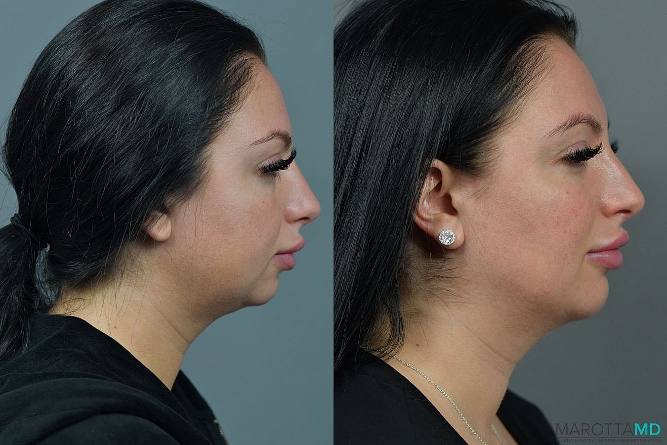 Buccal Fat Removal Before & After