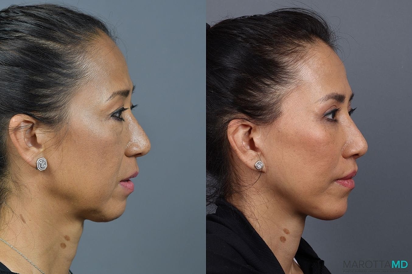 Buccal Fat Removal Before & After
