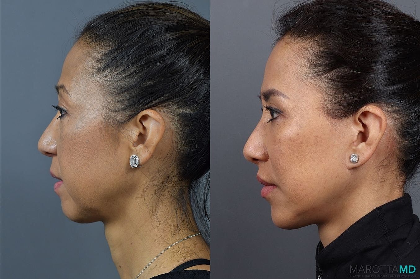 Mini Lift Before & After