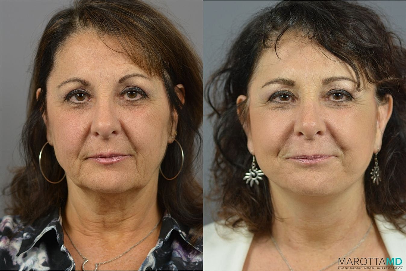 Mini Lift Before & After