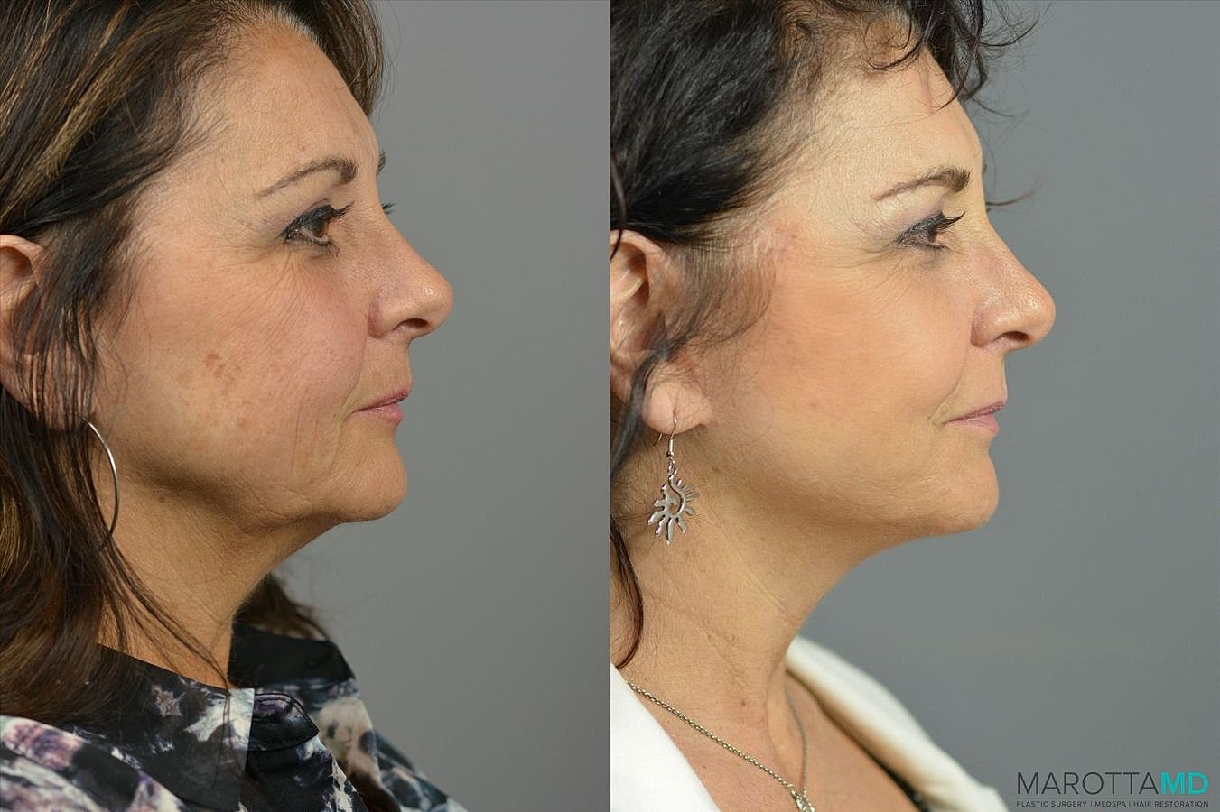 Mini Lift Before & After