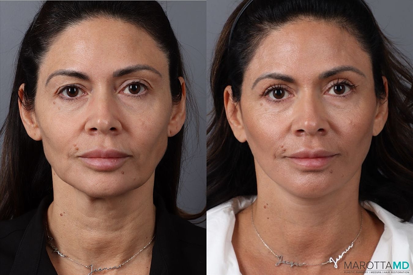 Mini Lift Before & After