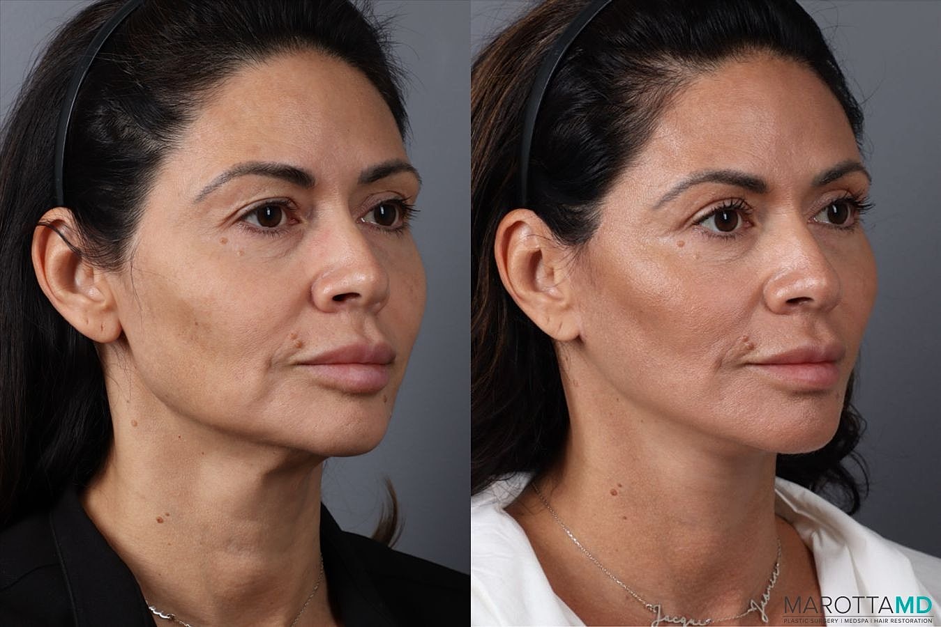 Mini Lift Before & After