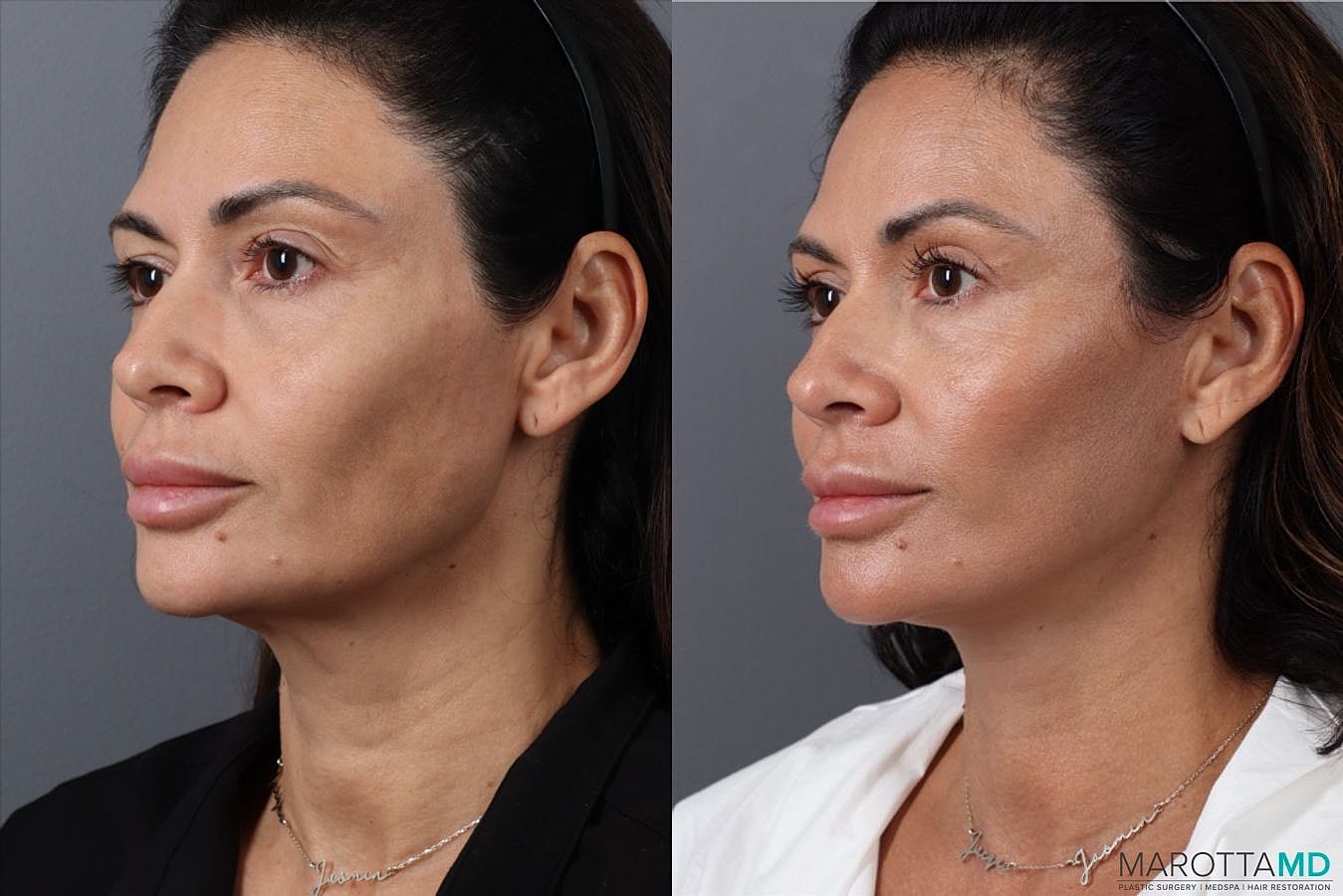 Mini Lift Before & After