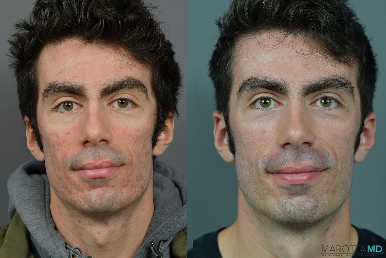 Genius Radio Frequency Microneedling Before & After