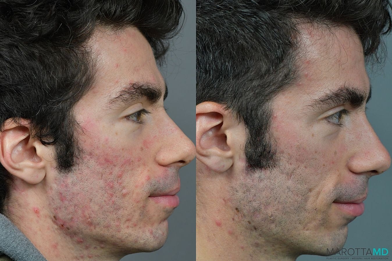 Genius Radio Frequency Microneedling Before & After