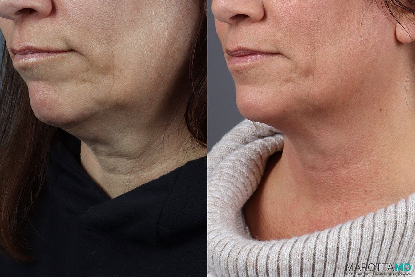 Genius Radio Frequency Microneedling Before & After