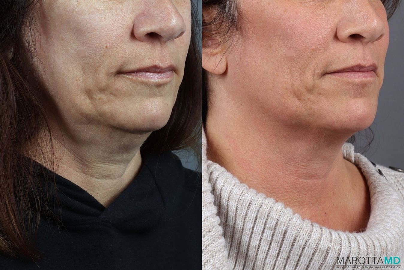 Genius Radio Frequency Microneedling Before & After
