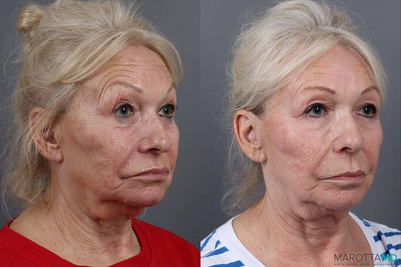 Genius Radio Frequency Microneedling Before & After
