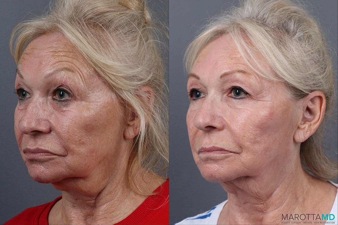 Genius Radio Frequency Microneedling Before & After