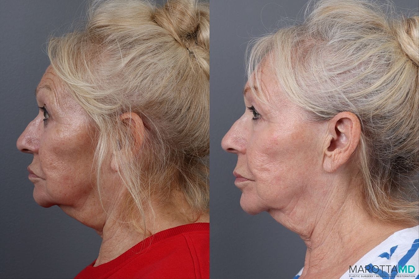 Genius Radio Frequency Microneedling Before & After