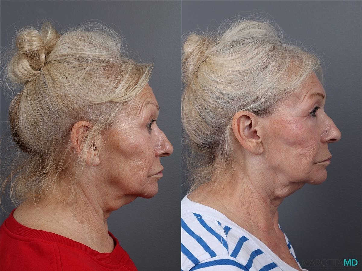 Genius Radio Frequency Microneedling Before & After