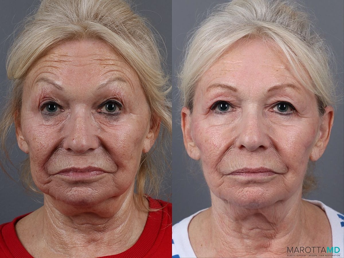 Genius Radio Frequency Microneedling Before & After