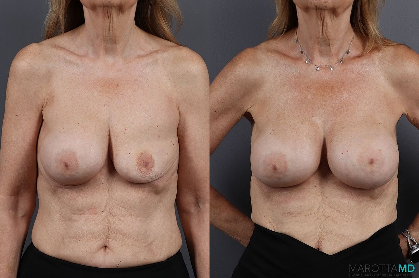 Implant Exchange Before & After