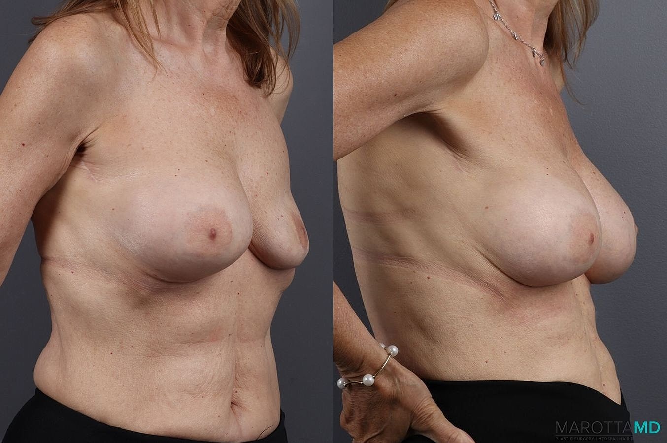Implant Exchange Before & After